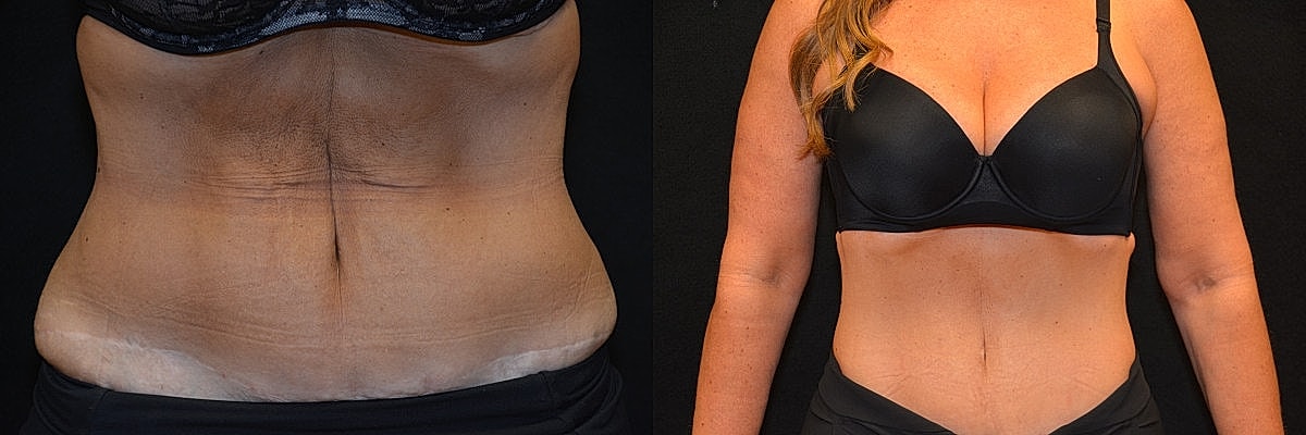 Reverse Abdominoplasty Before & After