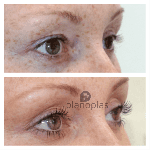 Plasma Pen Before & After