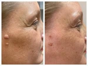 Plasma Pen Before & After