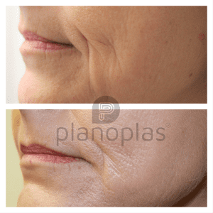 Plasma Pen Before & After