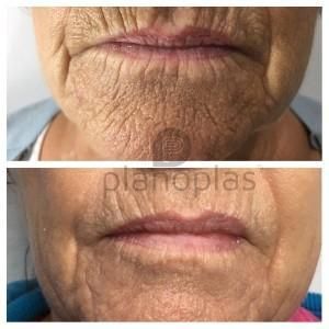 Plasma Pen Before & After