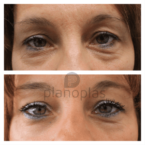 Plasma Pen Before & After