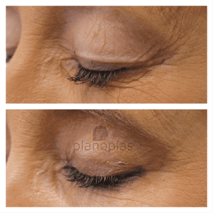 Plasma Pen Before & After