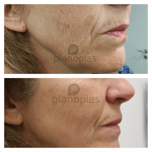 Plasma Pen Before & After