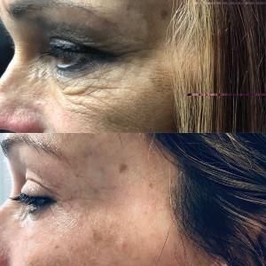 Plasma Pen Before & After