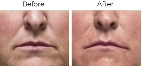 Radiesse Before & After