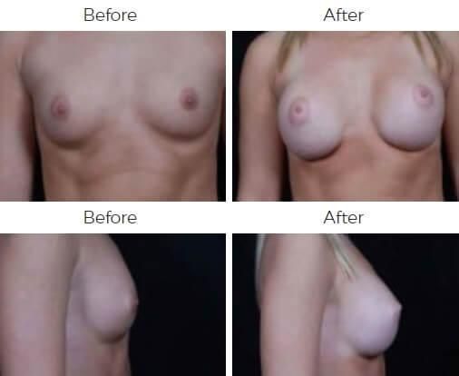 Breast Augmentation Before & After