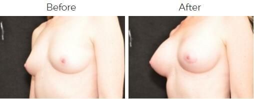 Breast Augmentation Before & After