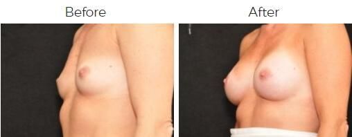 Breast Augmentation Before & After