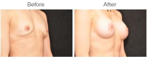Breast Augmentation Before & After