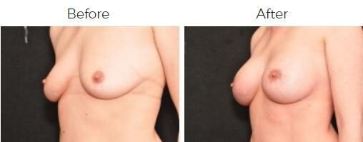 Breast Augmentation Before & After
