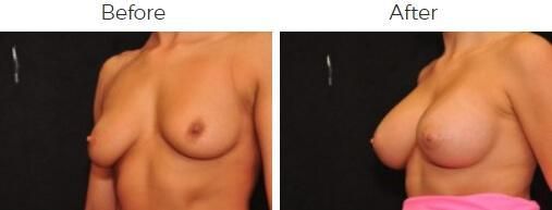 Breast Augmentation Before & After