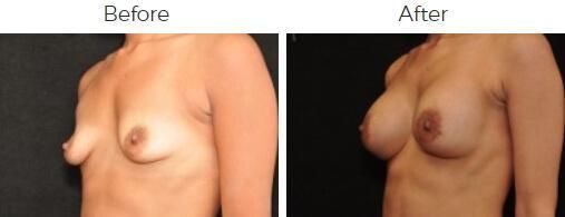Breast Augmentation Before & After