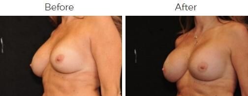 Breast Augmentation Before & After