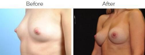 Breast Augmentation Before & After