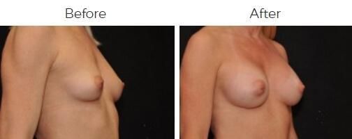 Breast Augmentation Before & After
