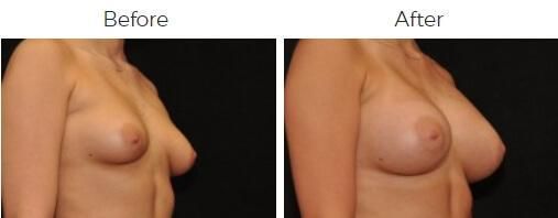 Breast Augmentation Before & After