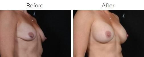 Breast Augmentation Before & After