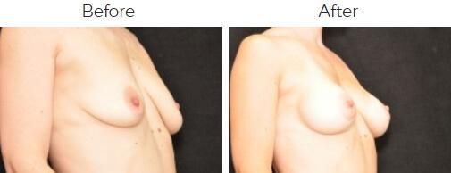 Breast Augmentation Before & After