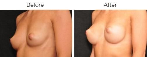 Breast Augmentation Before & After