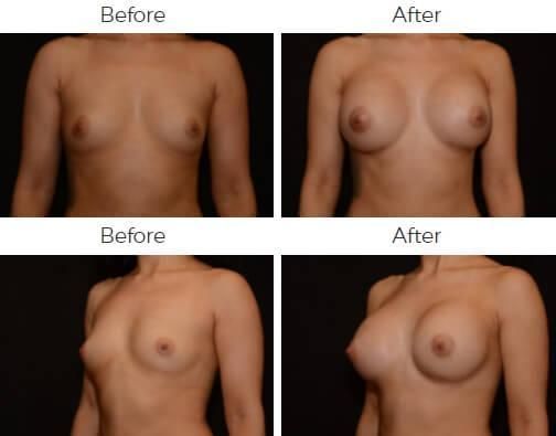 Breast Augmentation Before & After