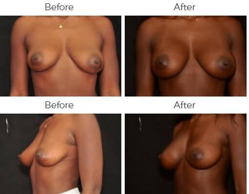 Breast Augmentation Before & After