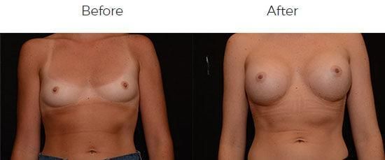 Breast Augmentation Before & After