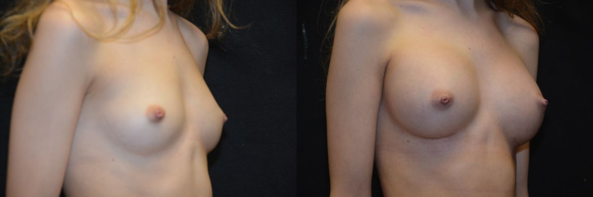 Breast Augmentation Before & After