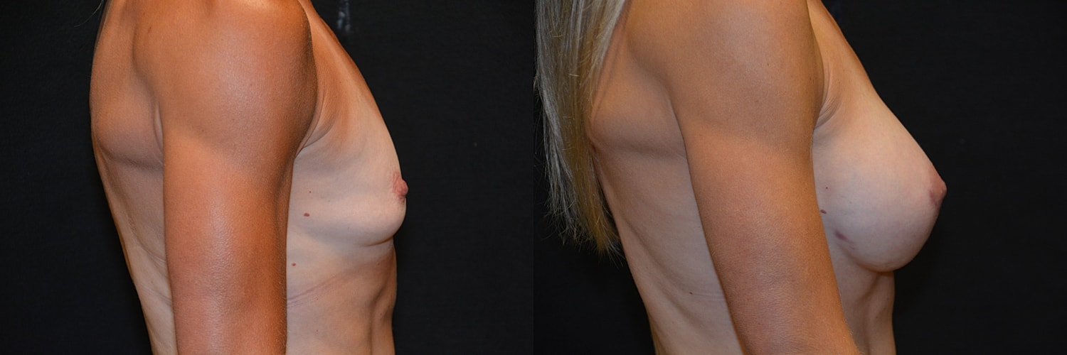Breast Augmentation Before & After