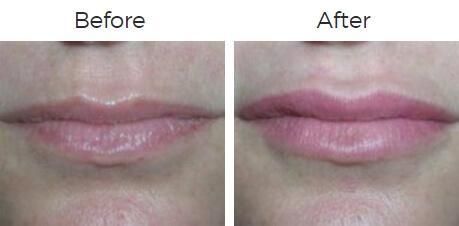 Restylane Before & After