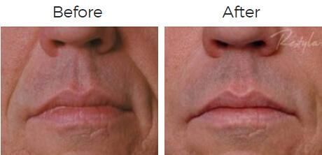 Restylane Before & After