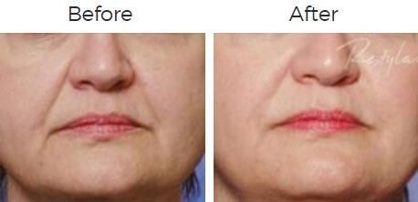 Restylane Before & After