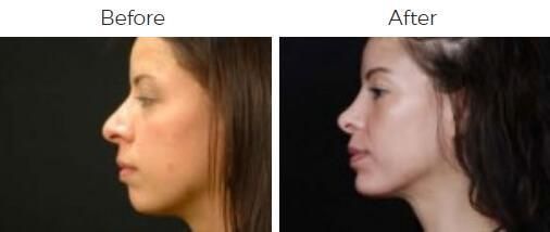 Rhinoplasty Before & After