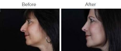 Rhinoplasty Before & After