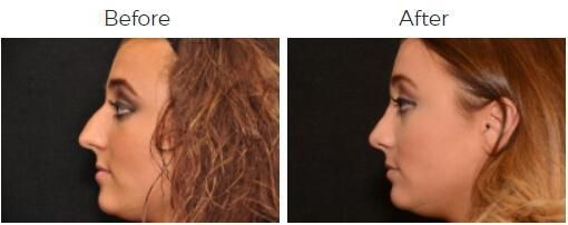 Rhinoplasty Before & After
