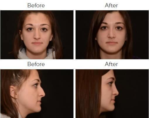 Rhinoplasty Before & After
