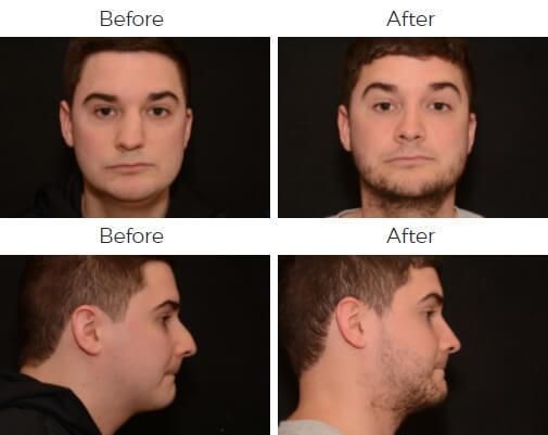 Rhinoplasty Before & After