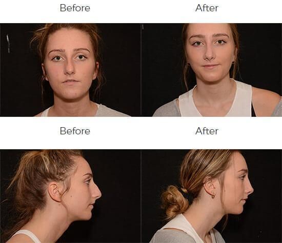 Rhinoplasty Before & After