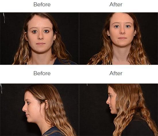 Rhinoplasty Before & After