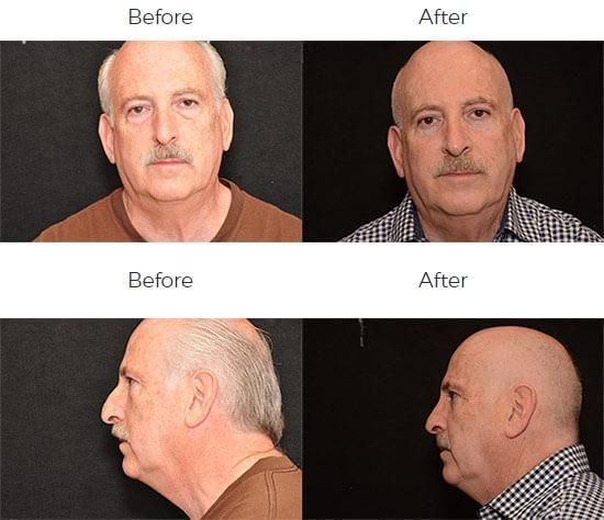 Rhinoplasty Before & After