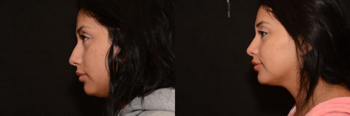 Rhinoplasty Before & After