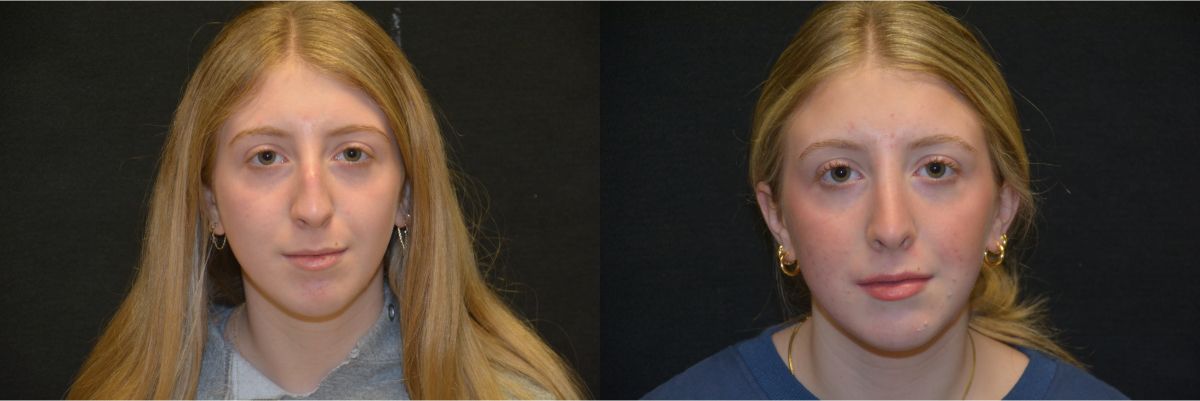 Rhinoplasty Before & After