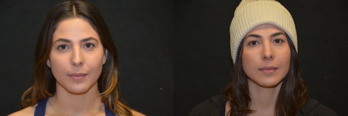 Rhinoplasty Before & After