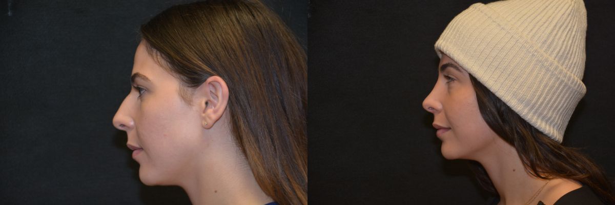Rhinoplasty Before & After