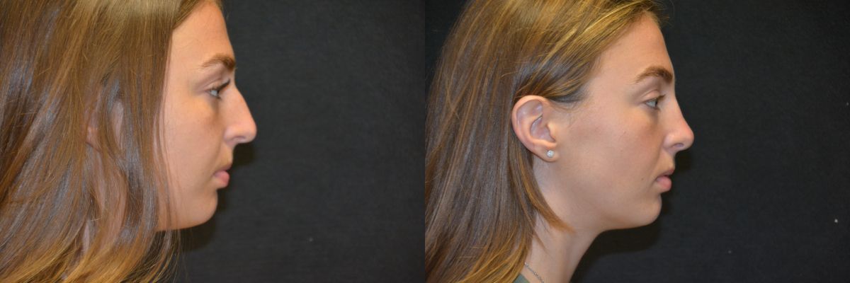 Rhinoplasty Before & After