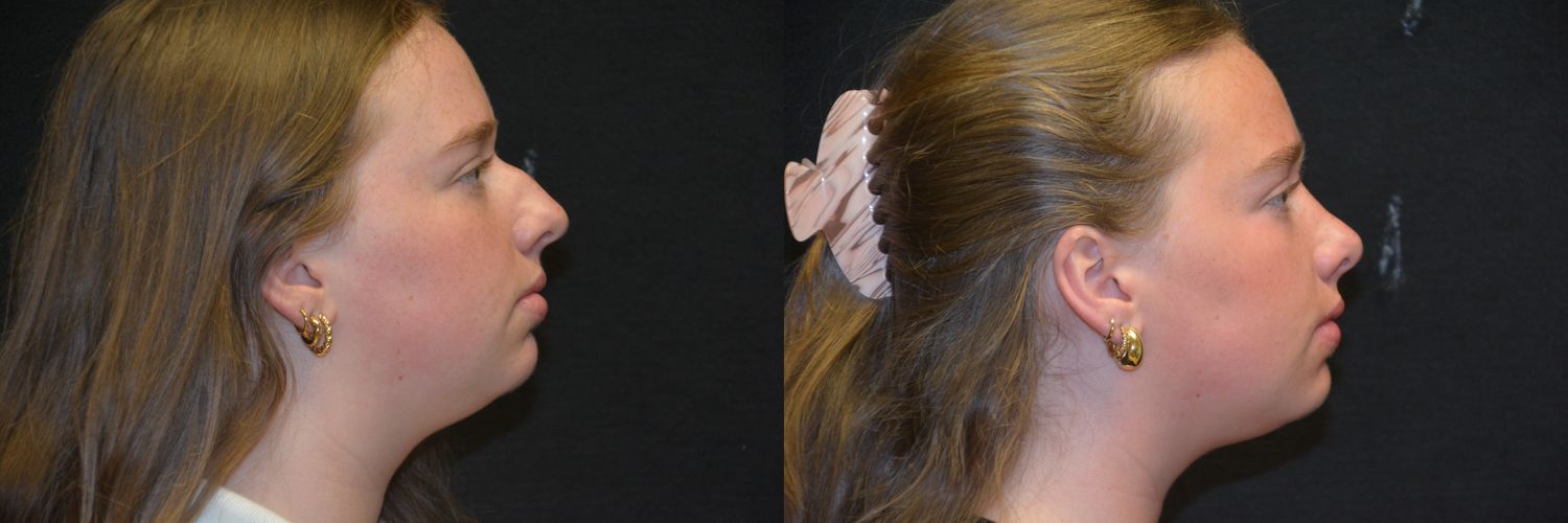 Rhinoplasty Before & After