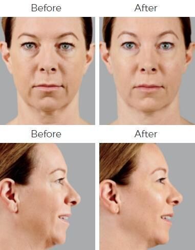 Voluma Before & After