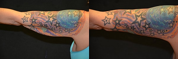 Arm Lift Before & After
