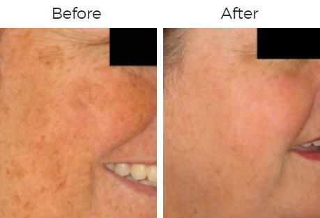Photofacial Ipl Before & After