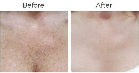 Photofacial Ipl Before & After